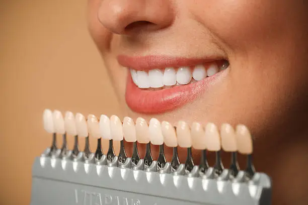 Sorriso perfetto con trattamenti di estetica dentale — Ambulatorio Odontoiatrico Privato Il Quadrifoglio